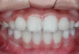 未使用滤光片的牙菌斑检测图