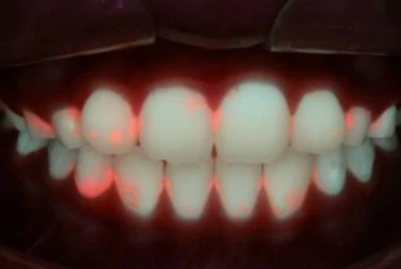 使用滤光片的牙菌斑检测图