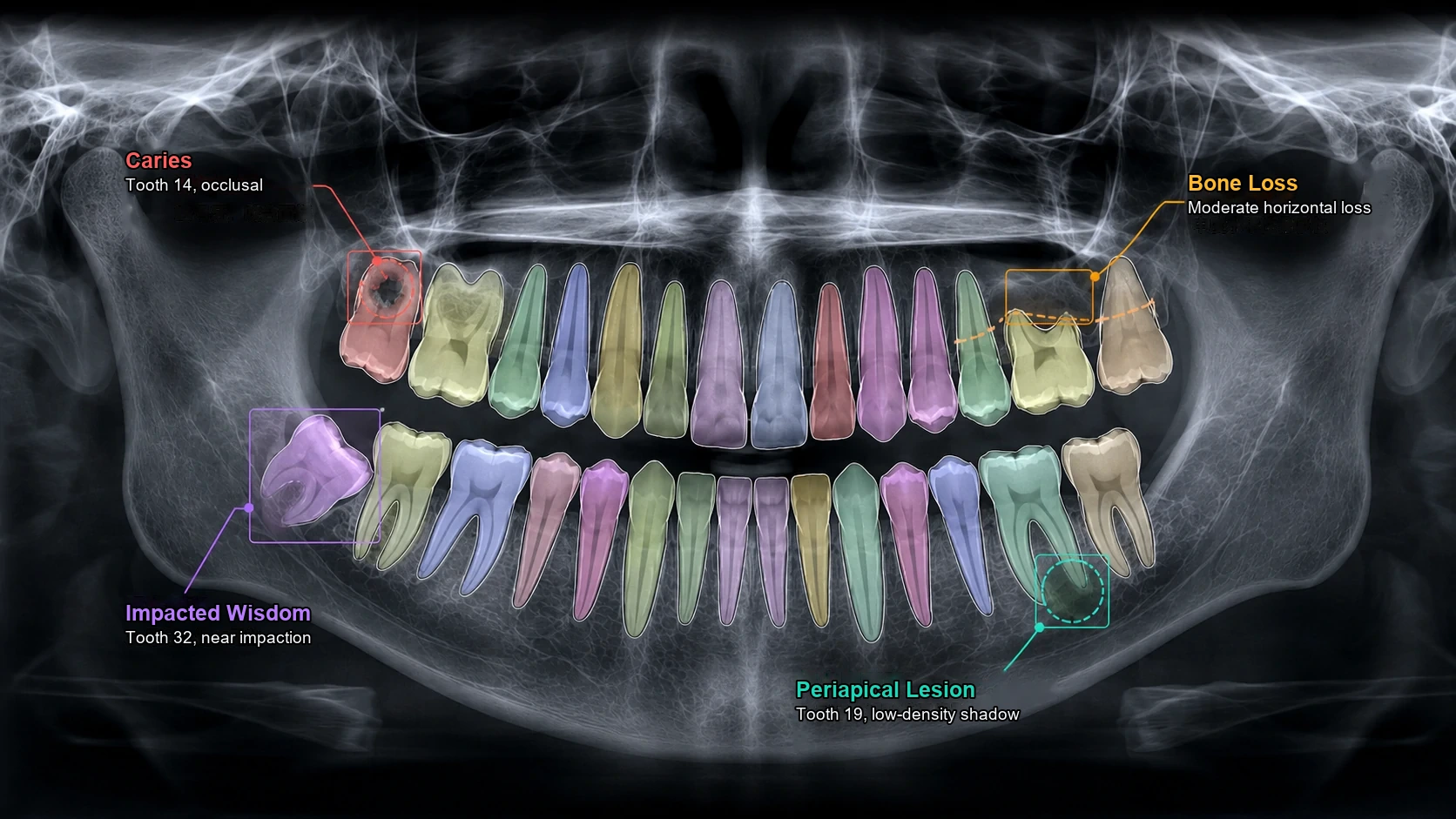 Panoramic X-ray AI detection and segmentation