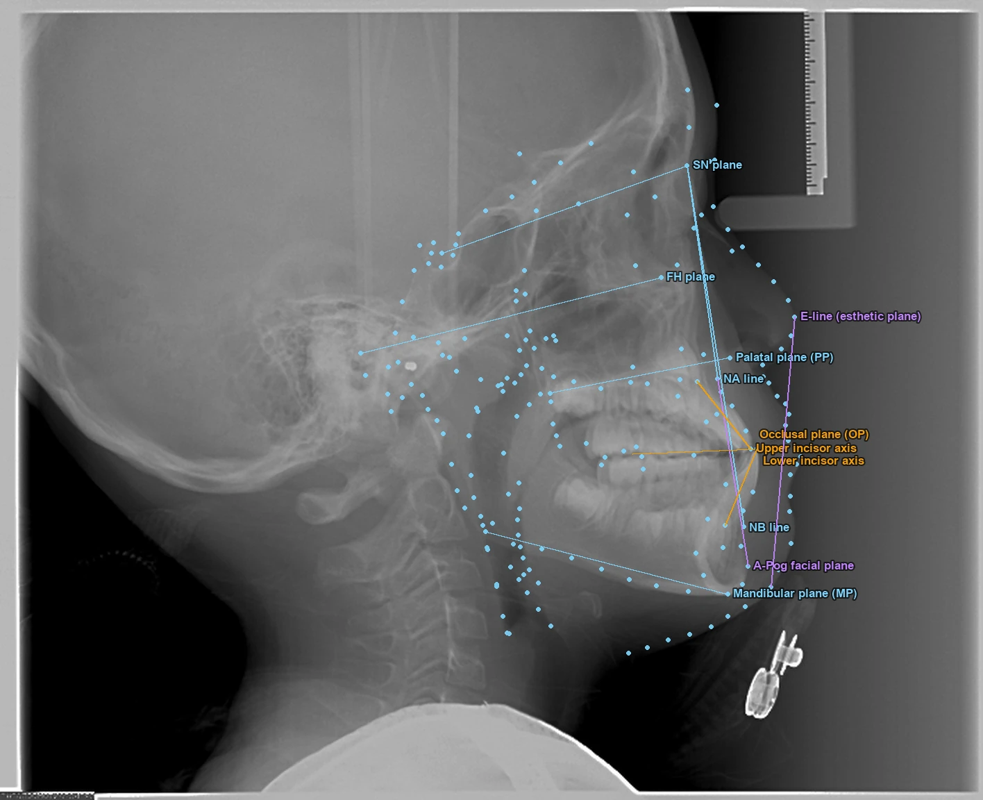 Lateral cephalogram: 201 landmarks and reference planes