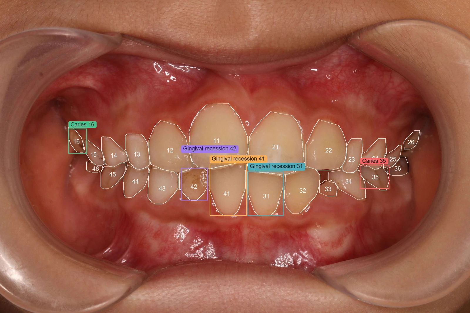 Intraoral photo: 52-class tooth segmentation and lesion detection