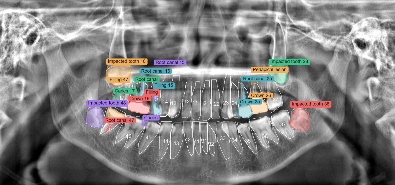 Panoramic X-ray: 48-class tooth segmentation and 20-class lesion detection