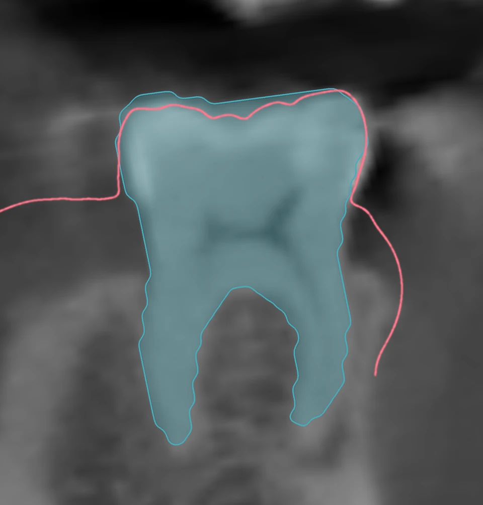 46 號牙 CBCT 切面:牙體與牙齦自動分割