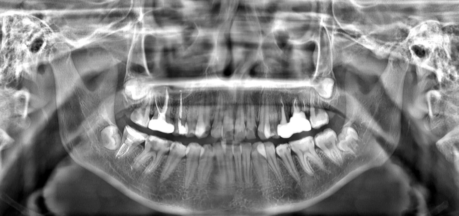 Original panoramic X-ray