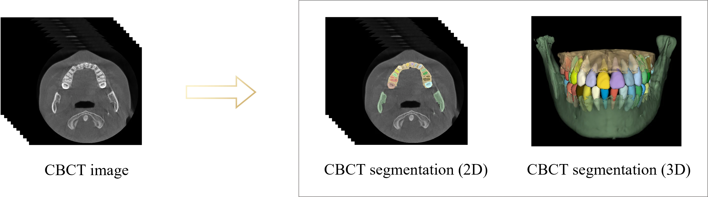 CBCT牙齿与骨骼分割效果图