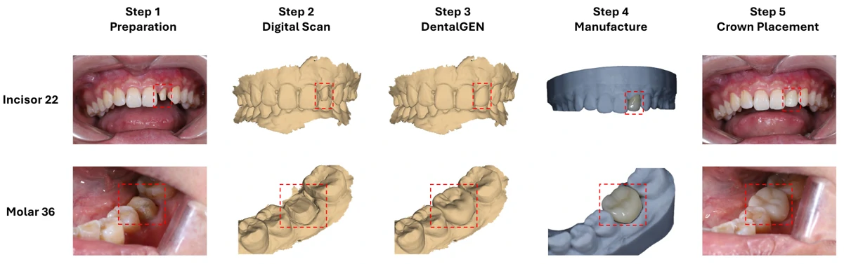 口腔修复冠设计效果图