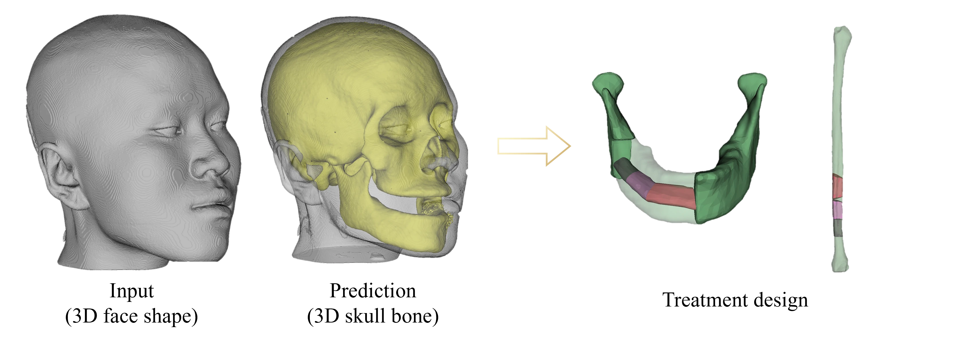 颌面外科手术规划效果图