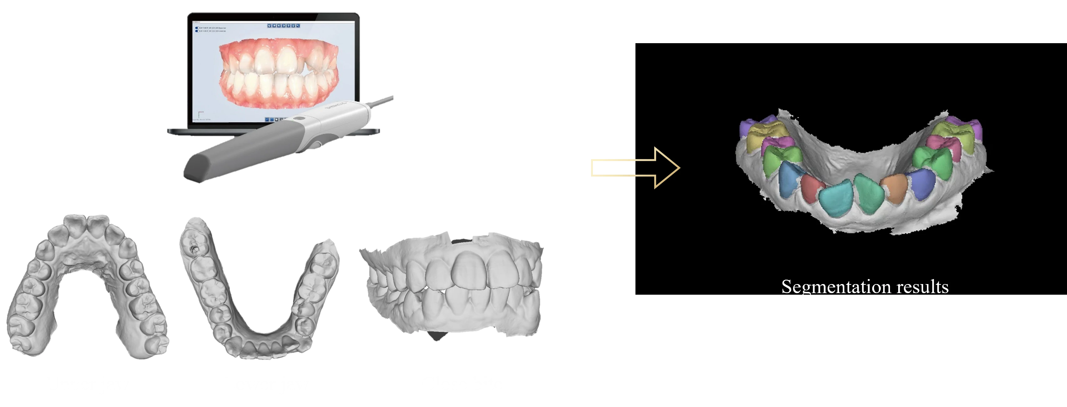 口扫数据牙齿分割效果图